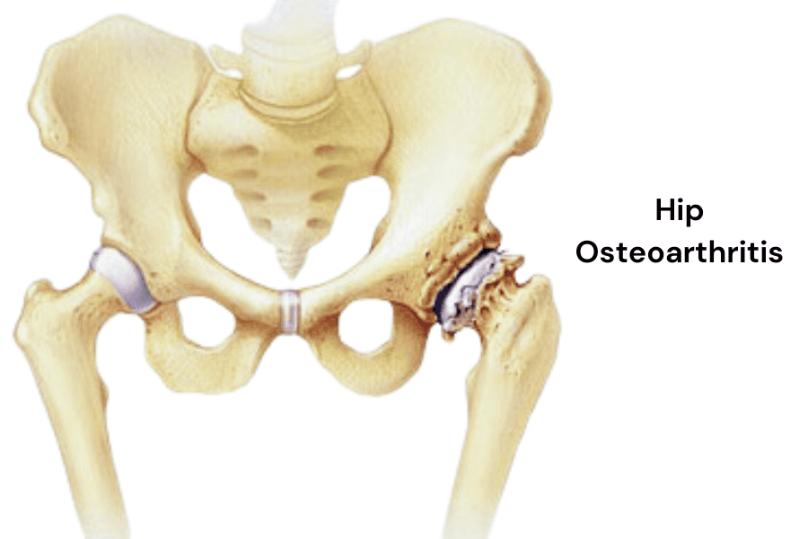 Illustration of bones with Osteoarthritis of the hip