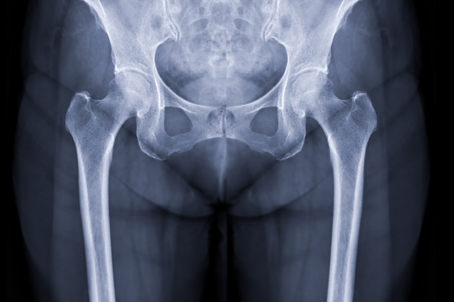 hip fractures