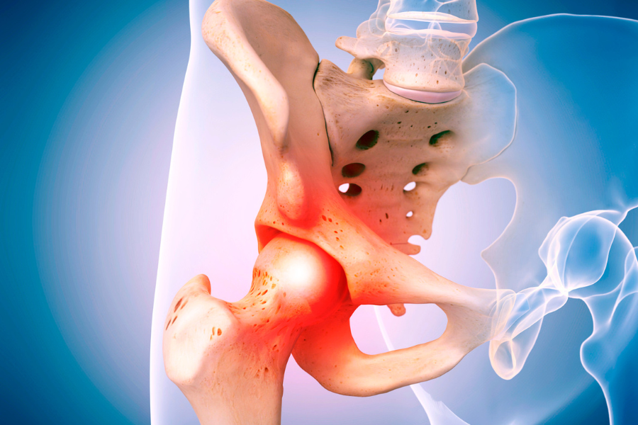 Hip Inflammatory Arthritis