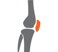 Meniscectomy–200×179 Meniscectomy